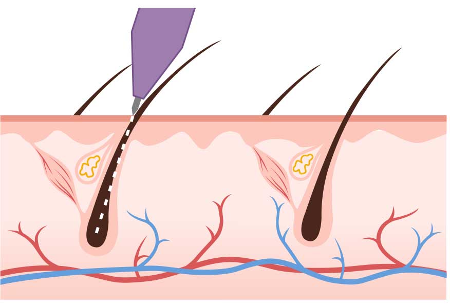 Epilation Fraxx Biomed